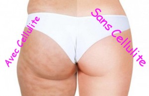 photo avec et sans celullite